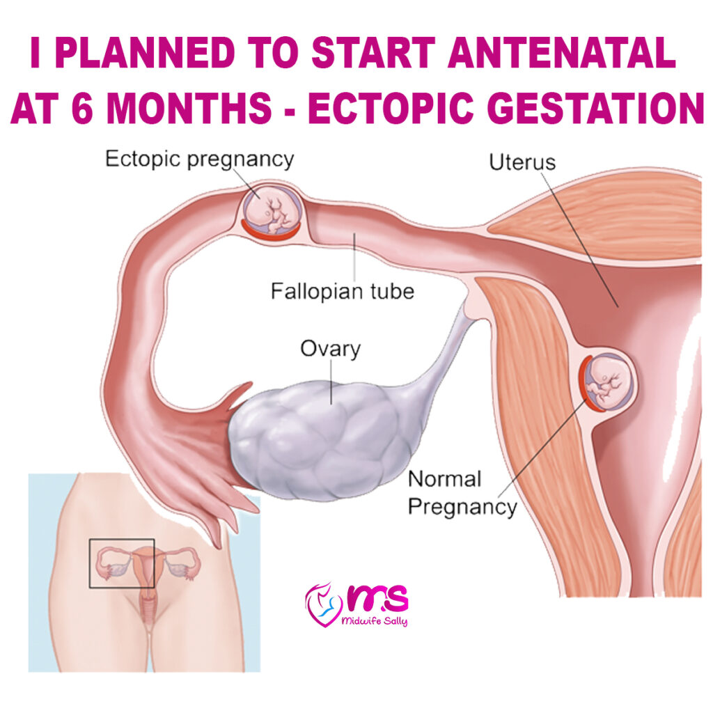 I PLANNED TO START ANTENATAL AT 6 MONTHS – ECTOPIC GESTATION