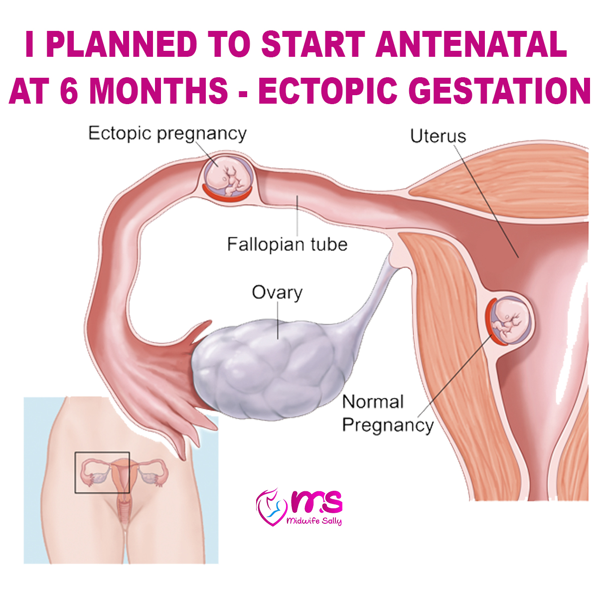 ECTOPIC GESTATION