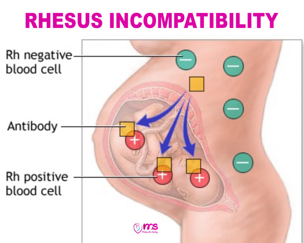 RHESUS INCOMPATIBILITY