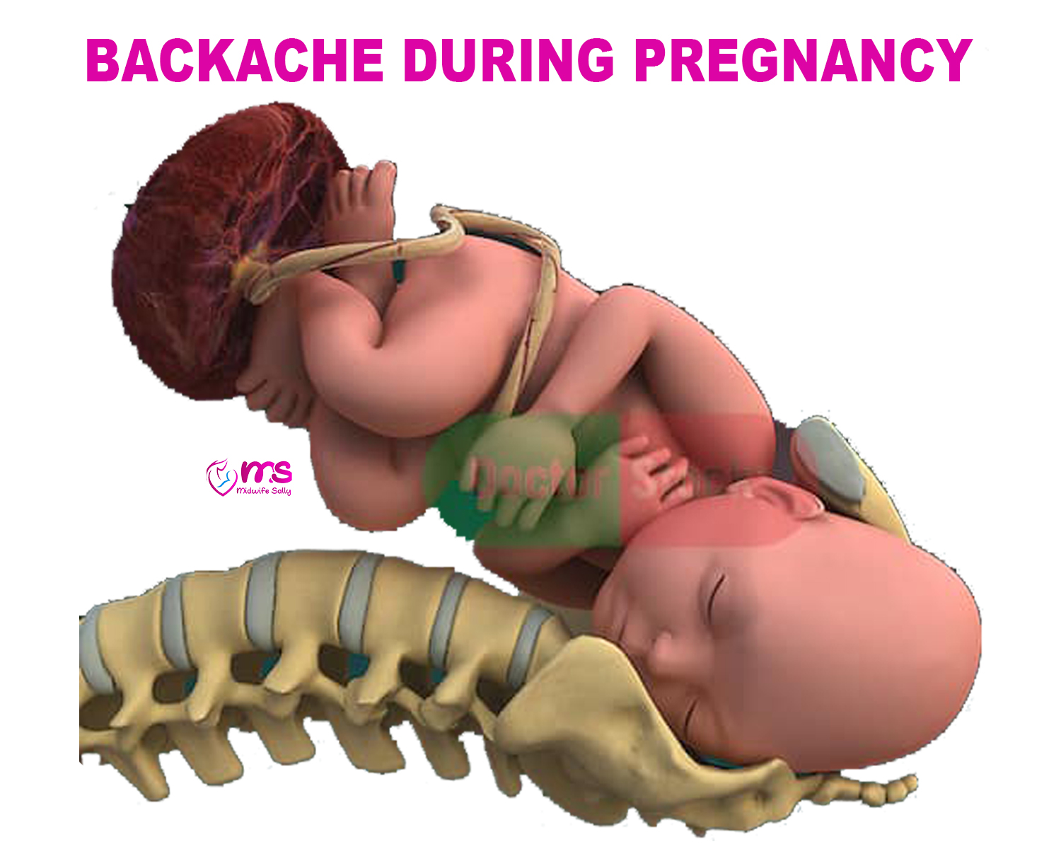 BACKACHE DURING PREGNANCY