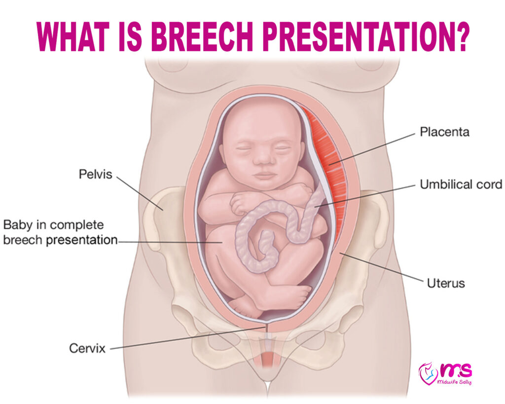 WHAT IS BREECH PRESENTATION?