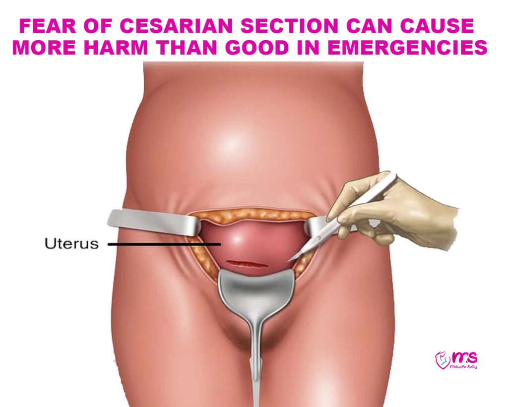 FEAR OF CESARIAN SECTION CAN CAUSE MORE HARM THAN GOOD IN EMERGENCIES