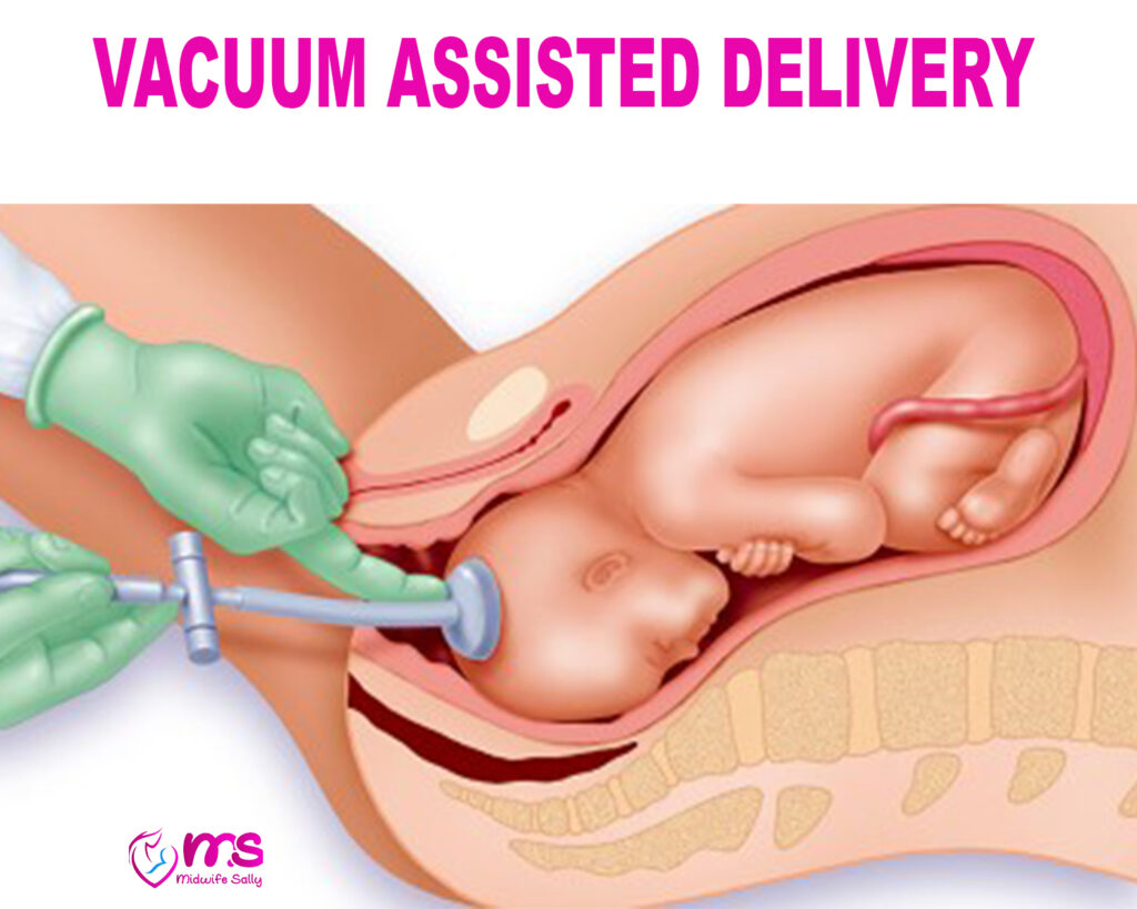 VACUUM ASSISTED DELIVERY