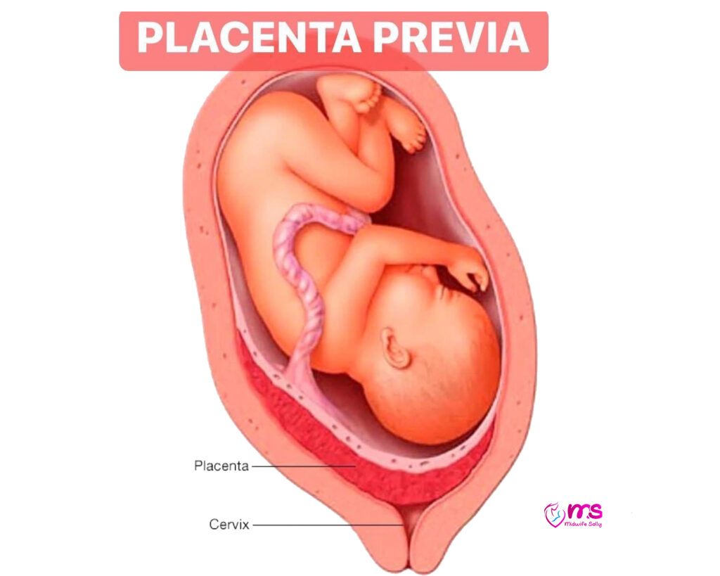 PLACENTA PREVIA