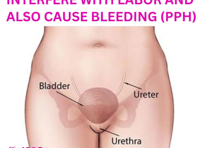 WHY A FULL BLADDER WILL INTERFERE WITH LABOR AND ALSO CAUSE BLEEDING (PPH)
