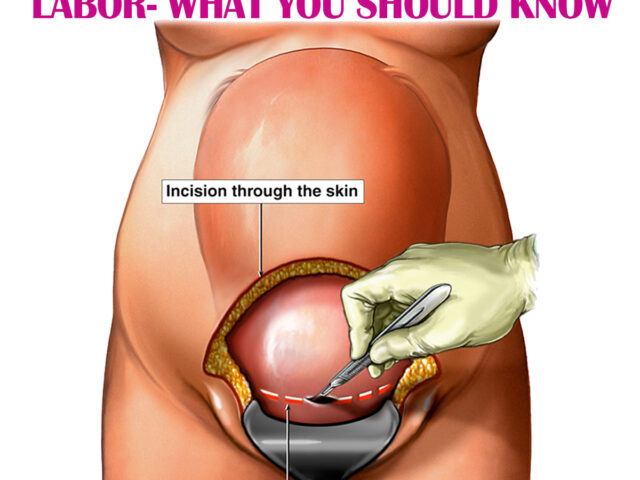PREVIOUS CESAREAN SECTION IN LABOR- WHAT YOU SHOULD KNOW