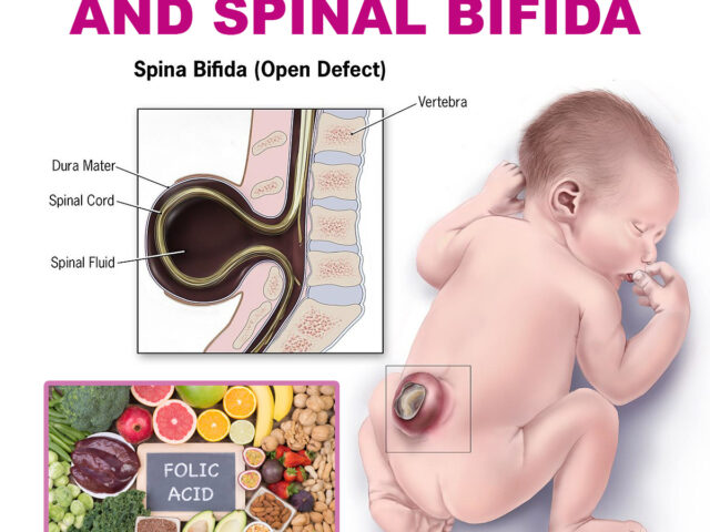 FOLIC ACID AND SPINAL BIFIDA