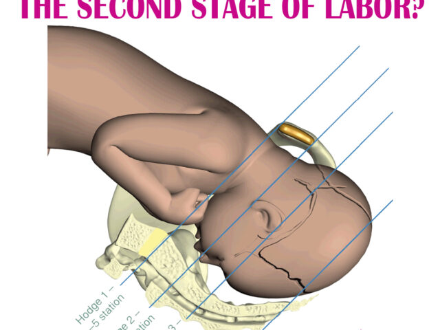 CROWNING DURING THE SECOND STAGE OF LABOR?
