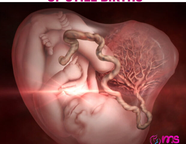 CAUSES AND PREVENTION OF STILL BIRTHS