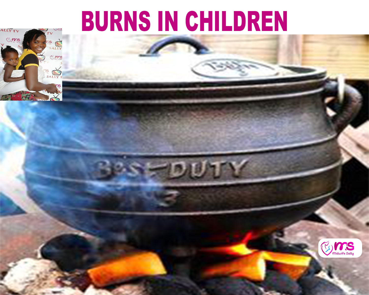 BURNS IN CHILDREN