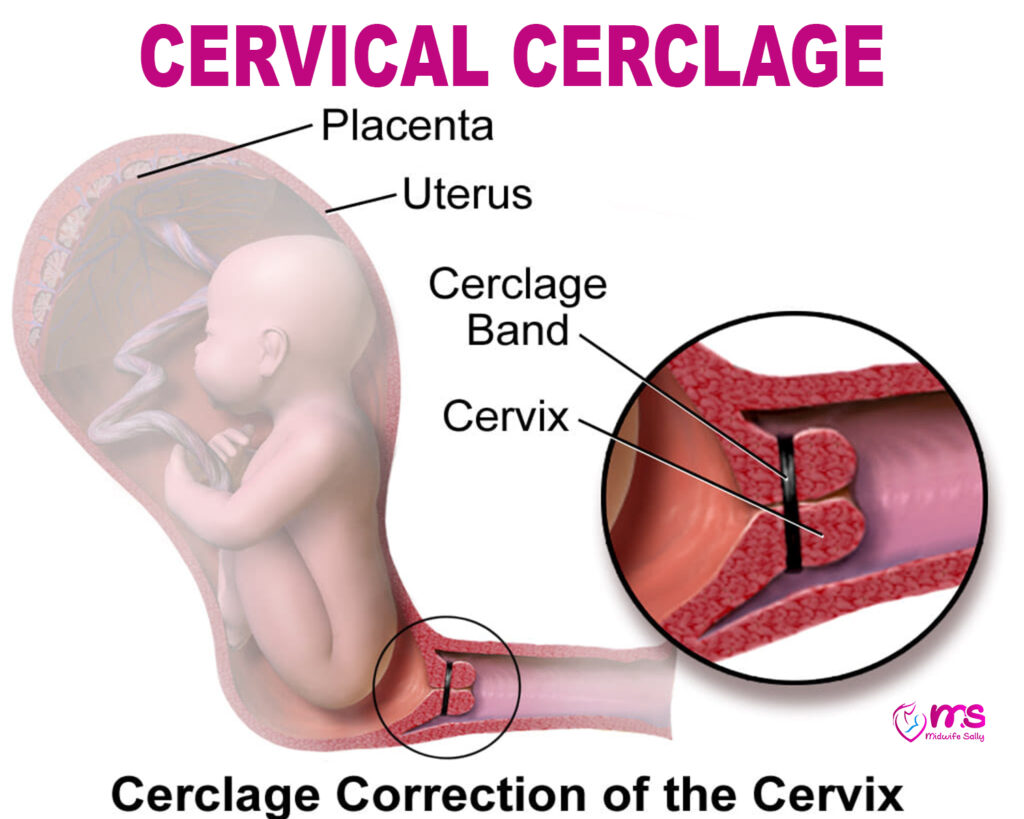 CERVICAL CERCLAGE