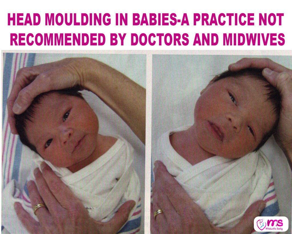 HEAD MOULDING IN BABIES-A PRACTICE NOT RECOMMENDED BY DOCTORS AND MIDWIVES