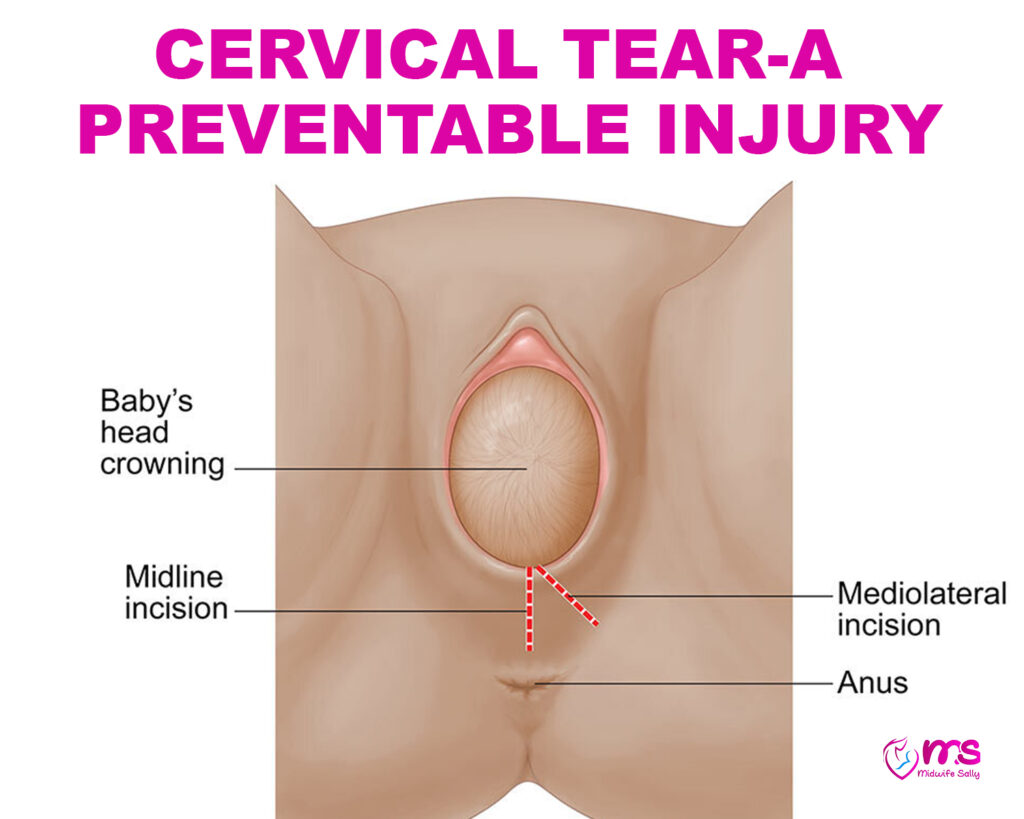 CERVICAL TEAR-A PREVENTABLE INJURY