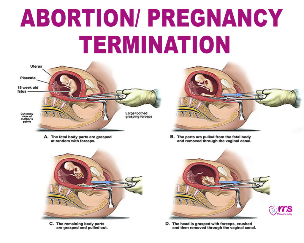 ABORTION/ PREGNANCY TERMINATION