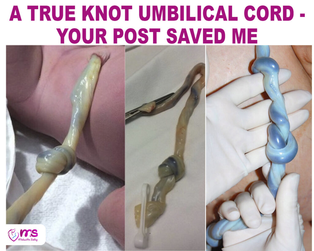 A TRUE KNOT UMBILICAL CORD – YOUR POST SAVED ME