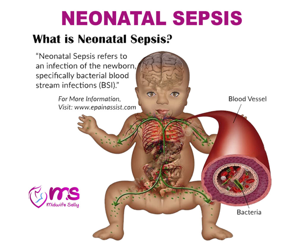 NEONATAL SEPSIS