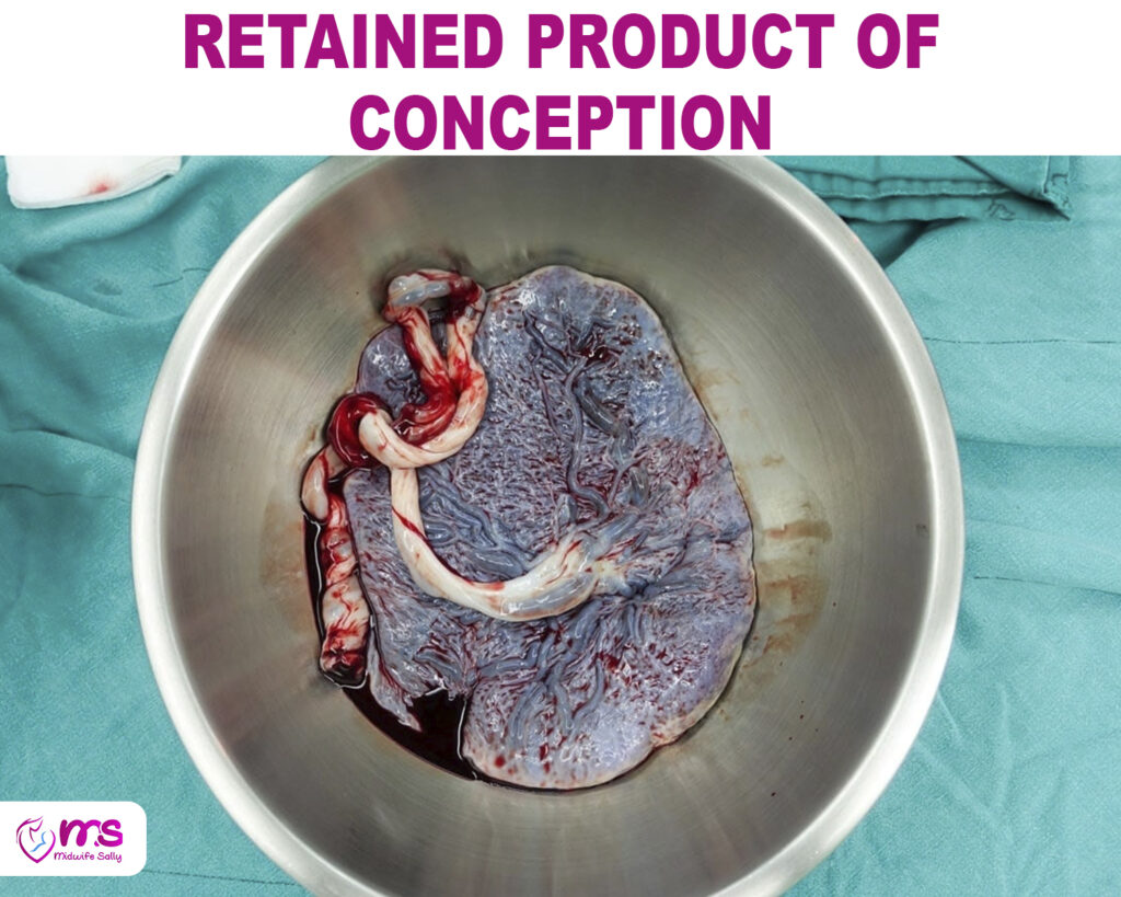 RETAINED PRODUCT OF CONCEPTION