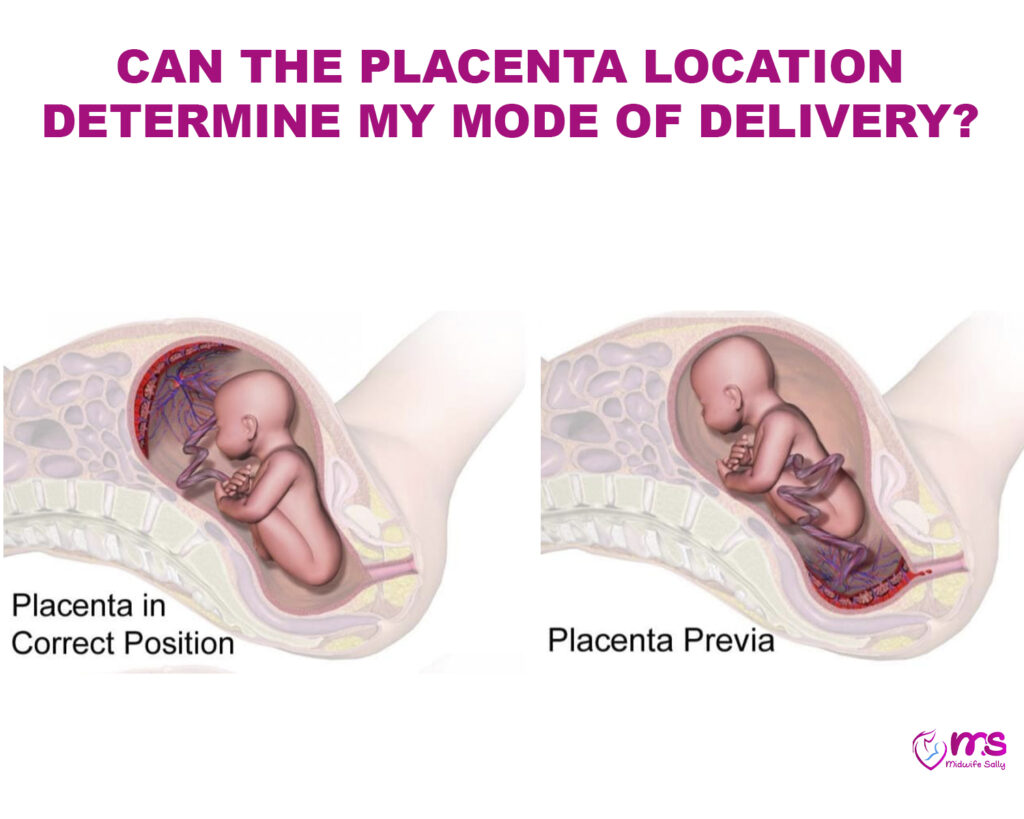 CAN THE PLACENTA LOCATION DETERMINE MY MODE OF DELIVERY?