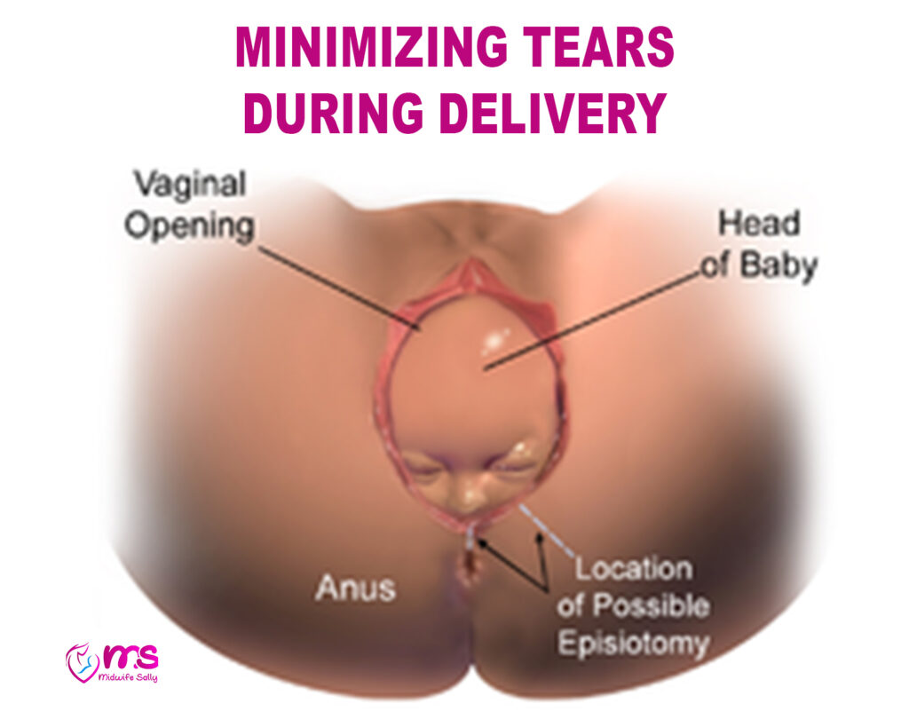 MINIMIZING TEARS DURING DELIVERY