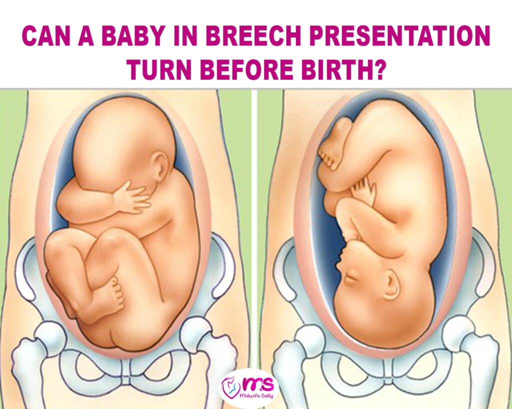 CAN A BABY IN BREECH PRESENTATION TURN BEFORE BIRTH?