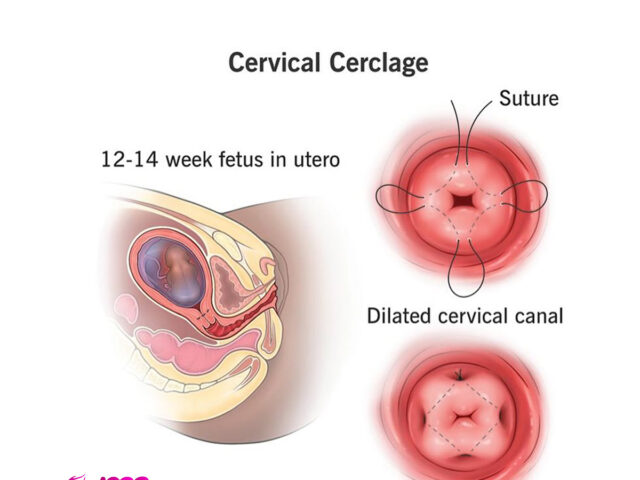 HOW CAN I OPEN MY CERVIX IF ITS SMALL?