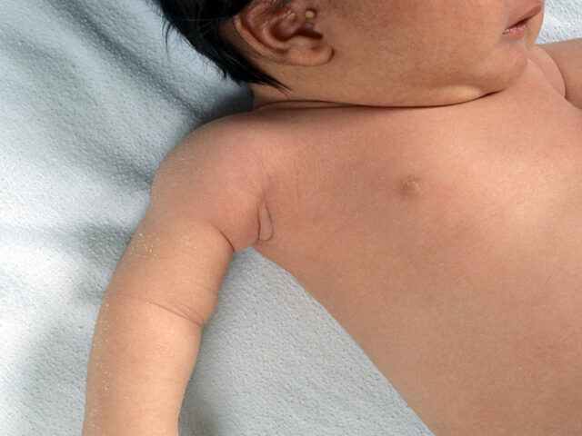 BIRTH INJURIES